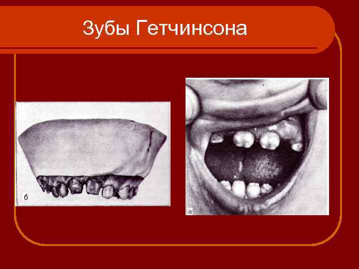 Зубы Гетчинсона 