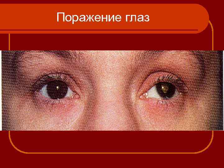 Поражение глаз 