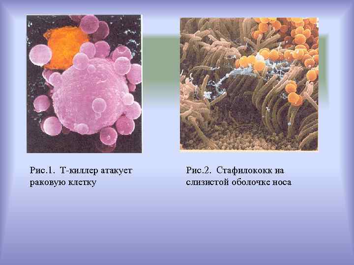 Рис. 1. Т-киллер атакует  Рис. 2. Стафилококк на раковую клетку  слизистой оболочке