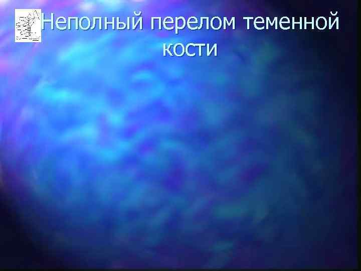 Неполный перелом теменной  кости 