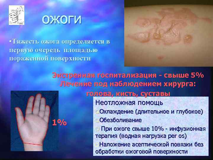    ожоги • Тяжесть ожога определяется в первую очередь площадью пораженной поверхности