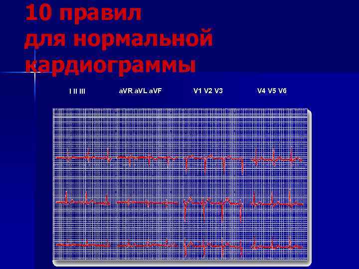 10 правил для нормальной кардиограммы I II III a. VR a. VL a. VF