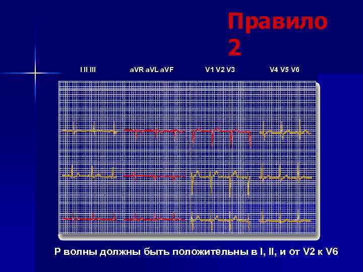 Правило 2 I II III a. VR a. VL a. VF V 1 V