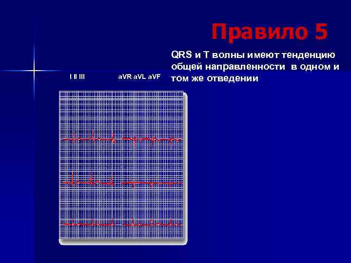 Правило 5 I II III a. VR a. VL a. VF QRS и T