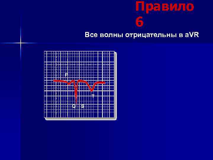 Правило 6 Все волны отрицательны в a. VR P T Q S 