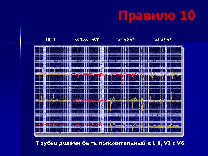 Правило 10 I II III a. VR a. VL a. VF V 1 V
