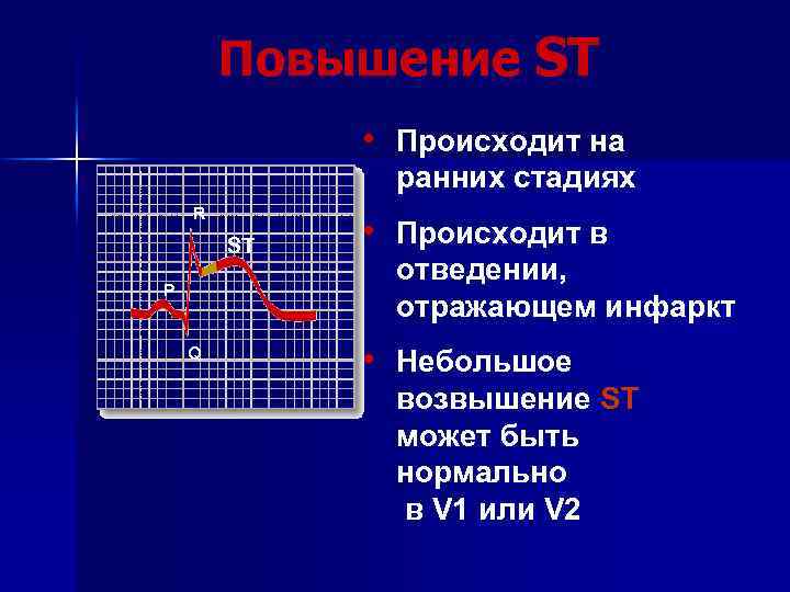 Повышение ST • Происходит на ранних стадиях R ST P Q • Происходит в