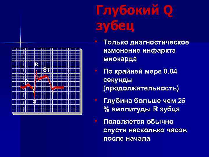 Глубокий Q зубец • Только диагностическое изменение инфаркта миокарда R • По крайней мере