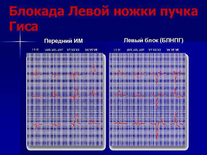 Блокада Левой ножки пучка Гиса Левый блок (БЛНПГ) Передний ИМ I II III a.