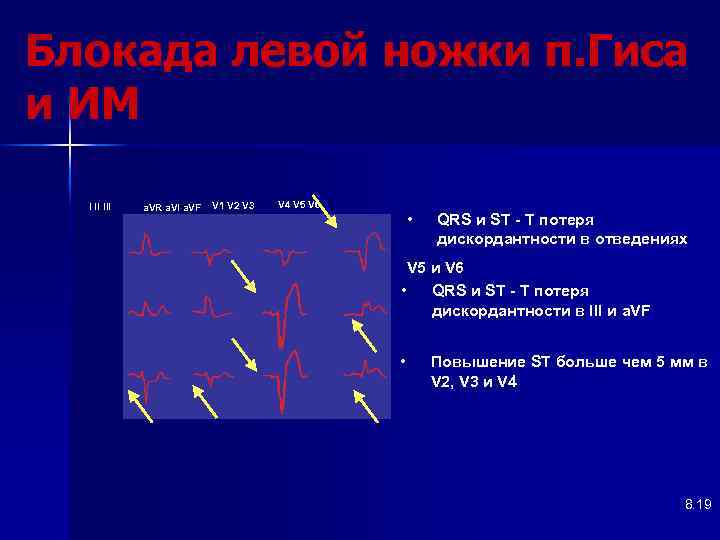 Блокада левой ножки п. Гиса и ИМ I II III a. VR a. VI