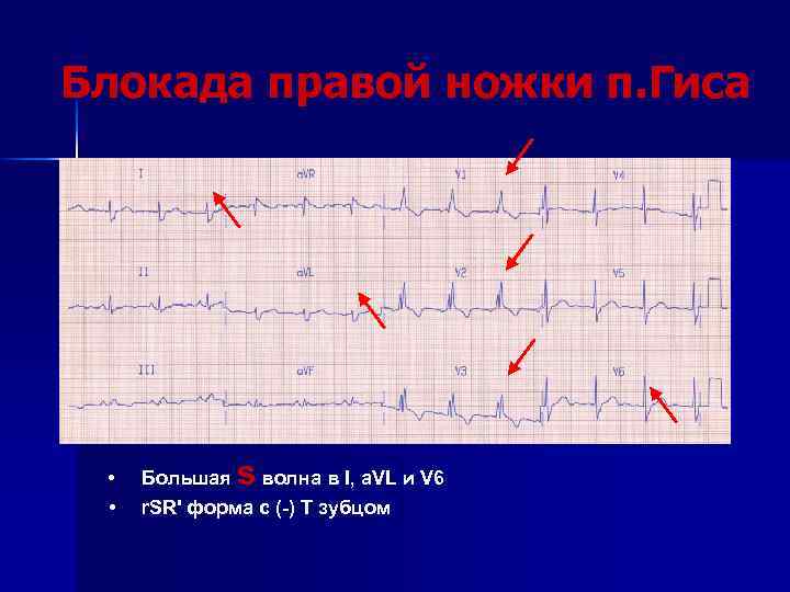 Блокада правой ножки п. Гиса • • Большая s волна в I, a. VL