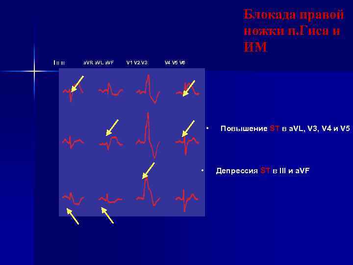 Блокада правой ножки п. Гиса и ИМ I II III a. VR a. VL