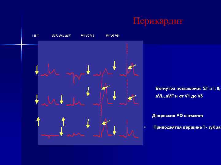 Перикардит I II III a. VR a. VL a. VF V 1 V 2