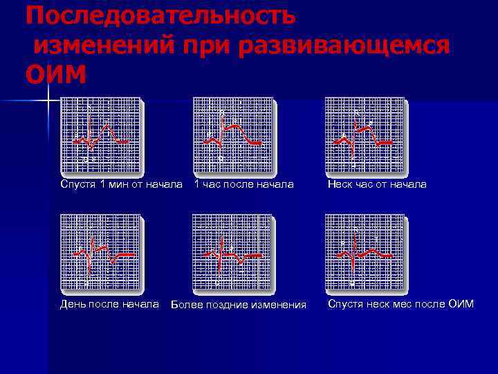 Последовательность изменений при развивающемся ОИМ R R R s T s P P P