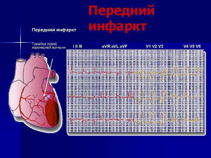 Передний инфаркт Тромбоз левой коронарной артерии I II III Передний инфаркт a. VR a.