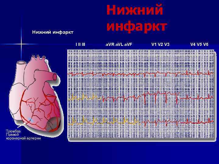 Нижний инфаркт I II III Тромбоз Правой коронарной артерии a. VR a. VL a.