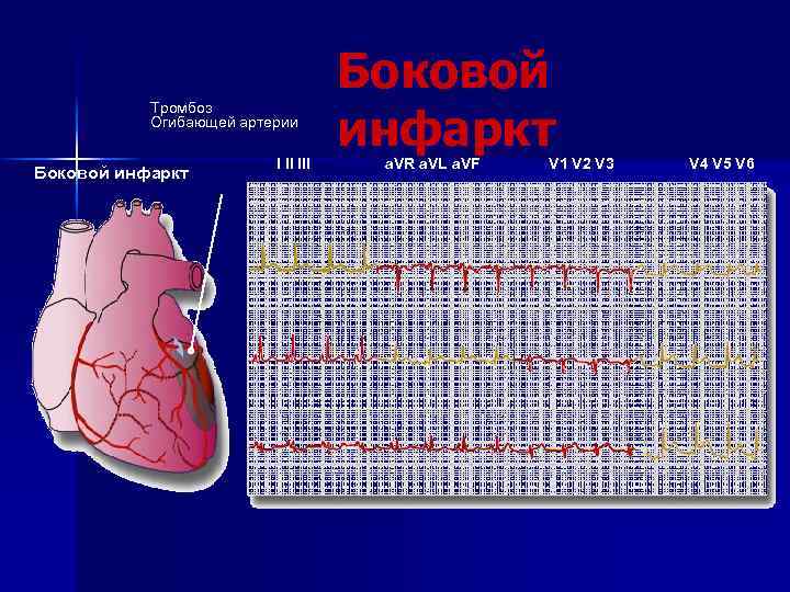 Тромбоз Огибающей артерии Боковой инфаркт I II III Боковой инфаркт a. VR a. VL