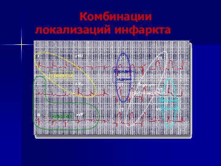 Комбинации локализаций инфаркта I a. VR V 4 Передне- БОКОВОЙ a. VL II V