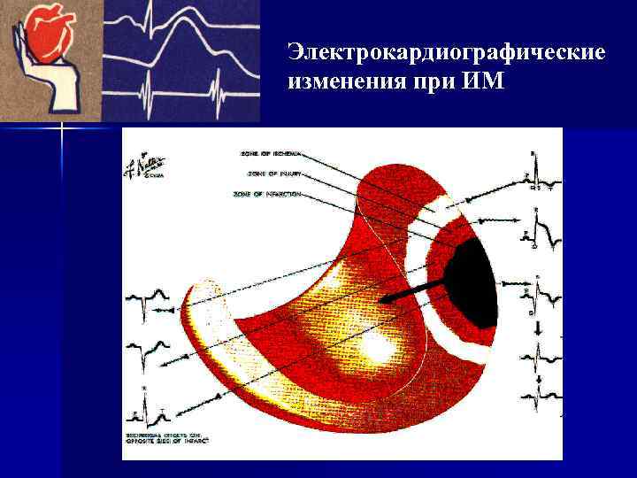 Электрокардиографические изменения при ИМ 