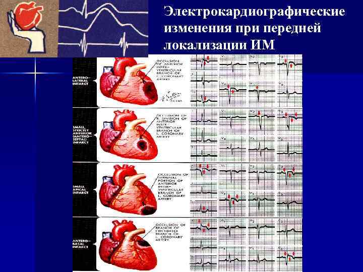 Электрокардиографические изменения при передней локализации ИМ 