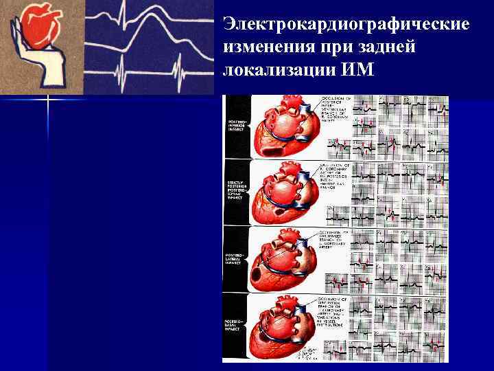 Электрокардиографические изменения при задней локализации ИМ 