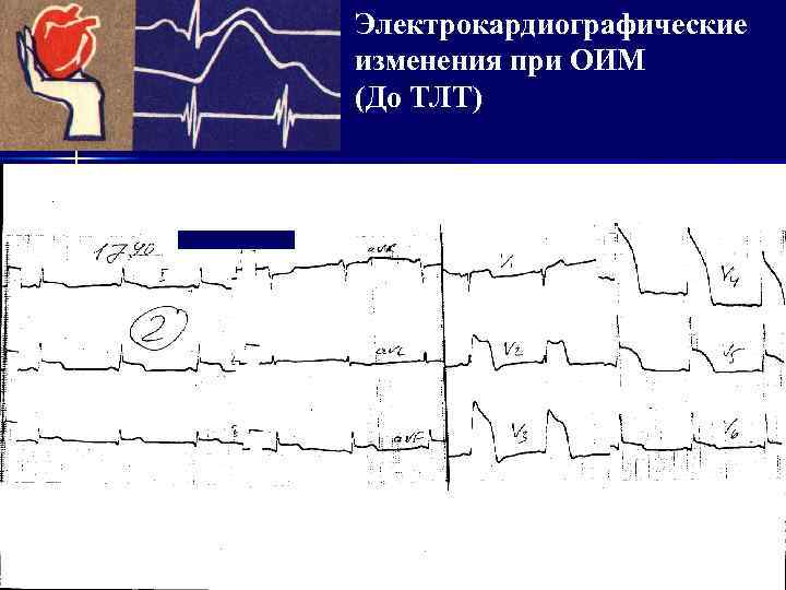 Электрокардиографические изменения при ОИМ (До ТЛТ) 