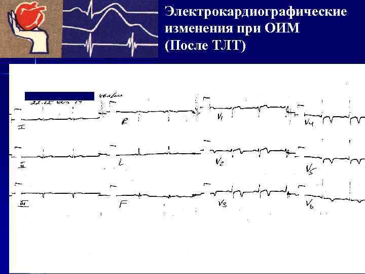 Электрокардиографические изменения при ОИМ (После ТЛТ) 