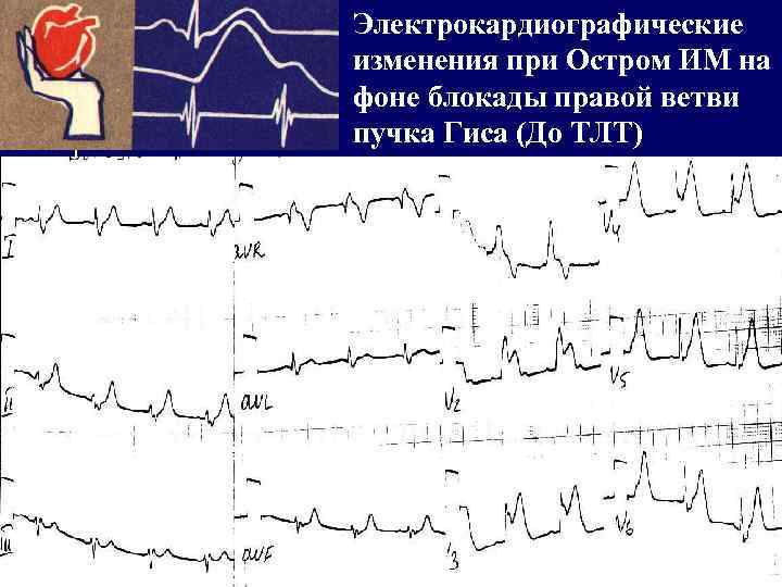Электрокардиографические изменения при Остром ИМ на фоне блокады правой ветви пучка Гиса (До ТЛТ)
