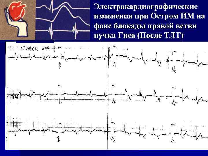 Электрокардиографические изменения при Остром ИМ на фоне блокады правой ветви пучка Гиса (После ТЛТ)