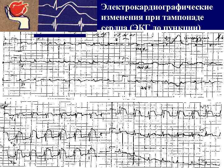 Расслаивающая аневризма карта вызова