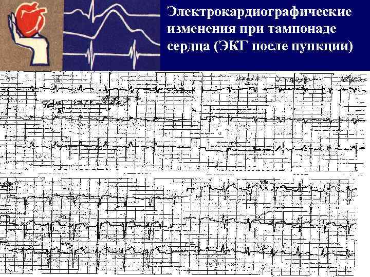 Электрокардиографические изменения при тампонаде сердца (ЭКГ после пункции) Диагноз: Расслаивающая аневризма аорты 