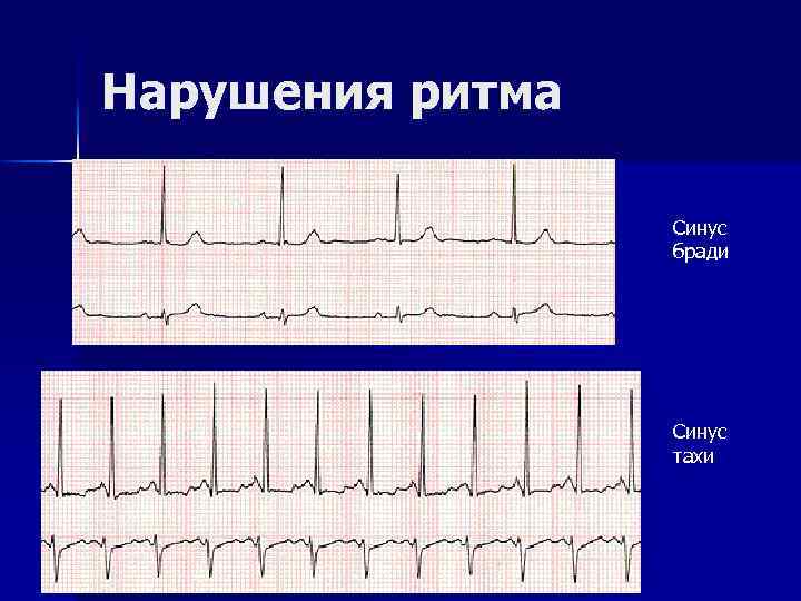 Нарушения ритма Синус бради Синус тахи 