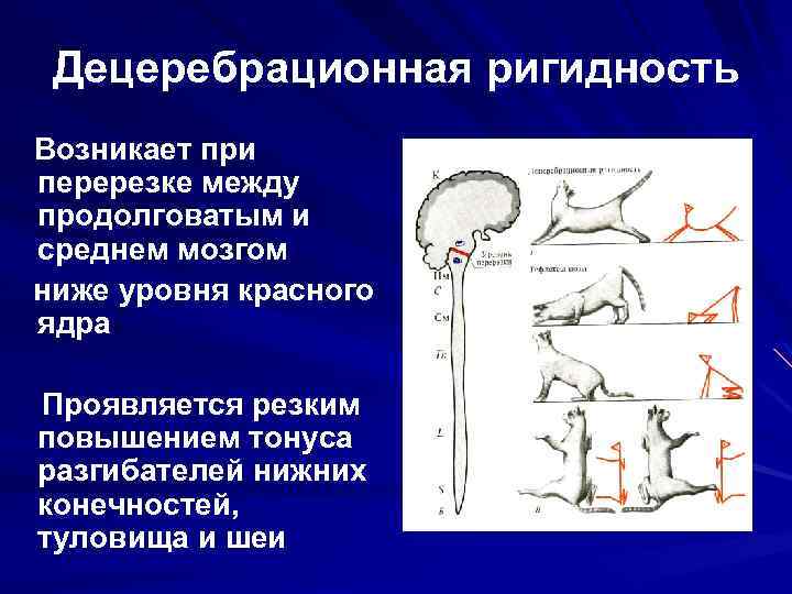 Децеребрационная ригидность Возникает при перерезке между продолговатым и среднем мозгом ниже уровня красного ядра