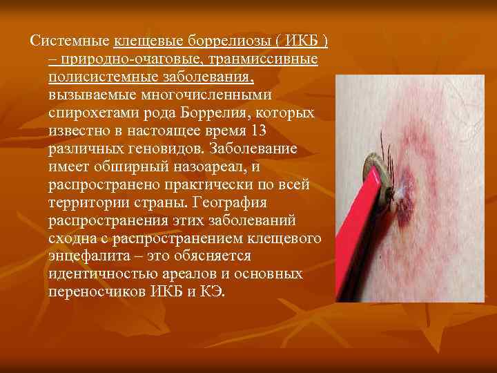 Системные клещевые боррелиозы ( ИКБ ) – природно-очаговые, транмиссивные полисистемные заболевания, вызываемые многочисленными спирохетами