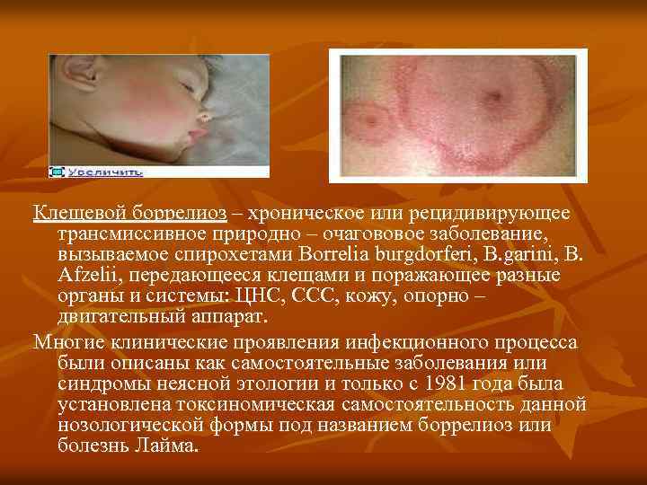 Клещевой боррелиоз – хроническое или рецидивирующее трансмиссивное природно – очагововое заболевание, вызываемое спирохетами Borrelia