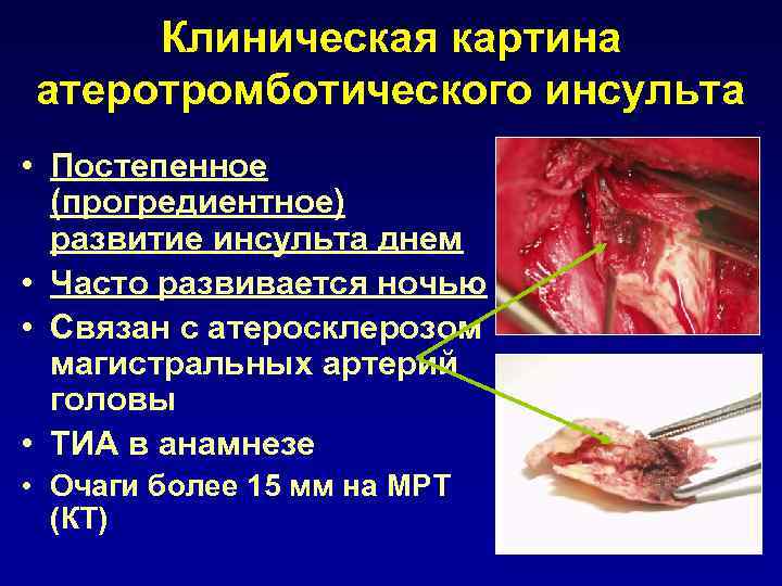 Клиническая картина атеротромботического инсульта • Постепенное (прогредиентное) развитие инсульта днем • Часто развивается ночью