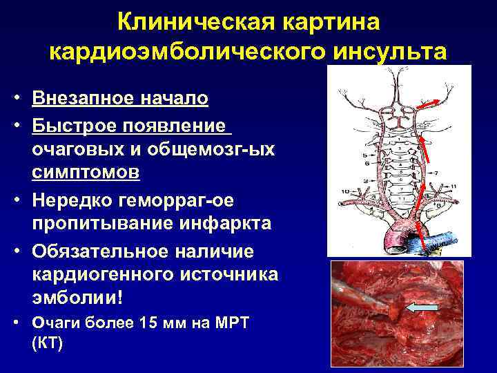 Клиническая картина кардиоэмболического инсульта • Внезапное начало • Быстрое появление очаговых и общемозг-ых симптомов