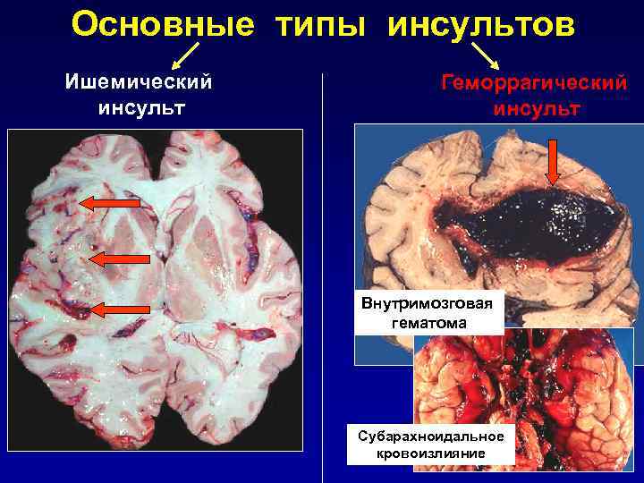 Основные типы инсультов Ишемический инсульт Геморрагический инсульт Внутримозговая гематома Субарахноидальное кровоизлияние 