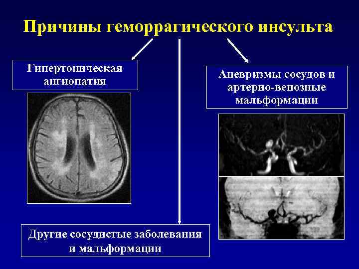 Причины геморрагического инсульта Гипертоническая ангиопатия Другие сосудистые заболевания и мальформации Аневризмы сосудов и артерио-венозные