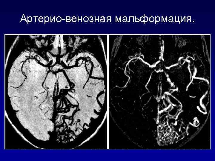 Артерио-венозная мальформация. 