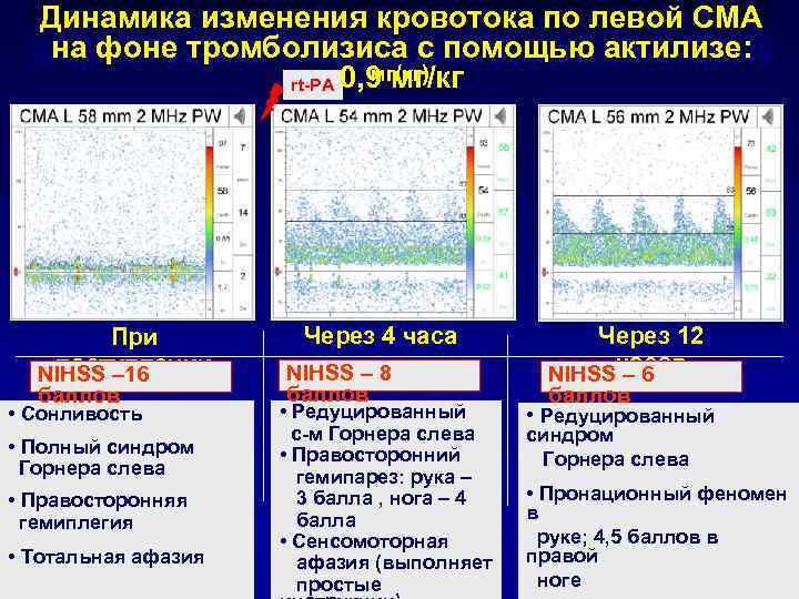 Динамика изменения кровотока по данным УЗДГ на фоне Динамика изменения кровотока по левой СМА