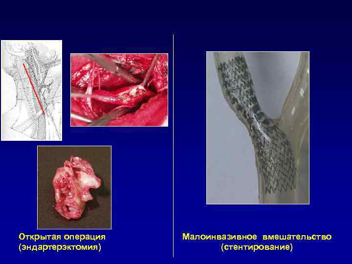 Открытая операция (эндартерэктомия) Малоинвазивное вмешательство (стентирование) 