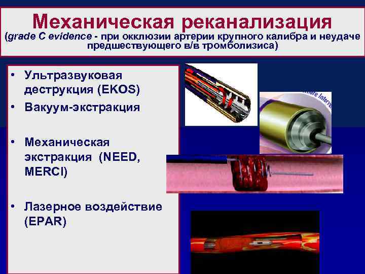 Механическая реканализация (grade C evidence - при окклюзии артерии крупного калибра и неудаче предшествующего