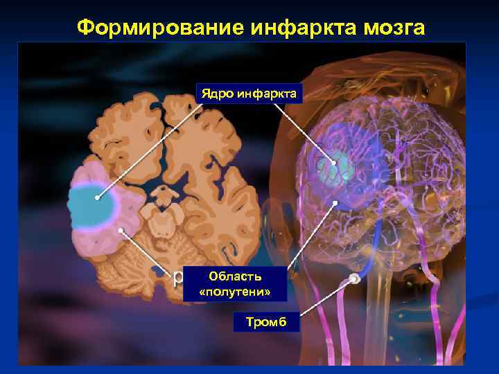 Формирование инфаркта мозга Ядро инфаркта Область «полутени» Тромб 