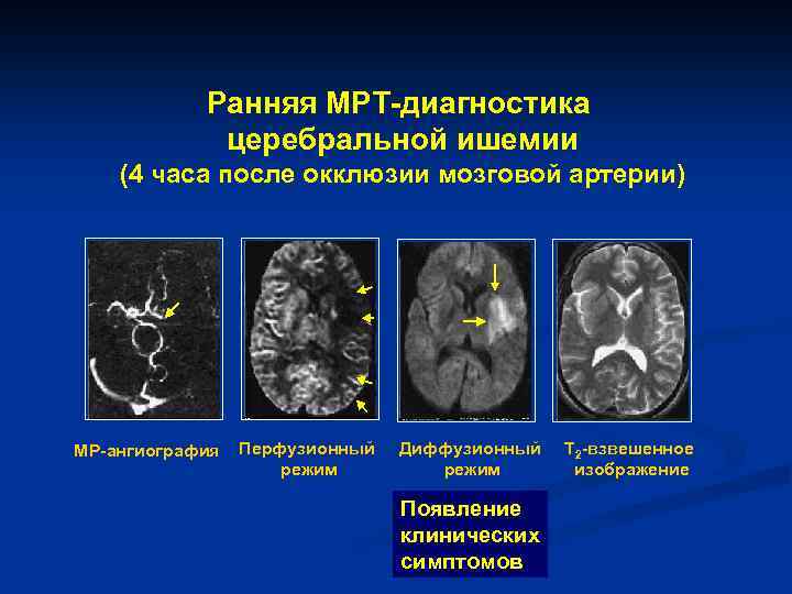 Ранняя МРТ-диагностика церебральной ишемии (4 часа после окклюзии мозговой артерии) МР-ангиография Перфузионный режим Диффузионный