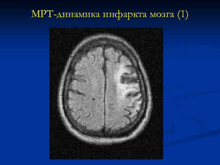 МРТ-динамика инфаркта мозга (1) 12 часов 3 -и сутки 7 -е сутки 21 -е