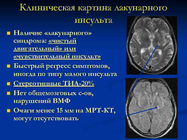 Клиническая картина лакунарного инсульта n n n Наличие «лакунарного» синдрома: «чистый двигательный» или «чувствительный