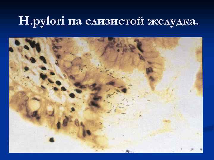 H. pylori на слизистой желудка. 