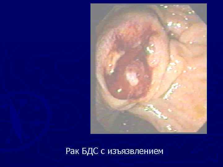 Рак БДС с изъязвлением 