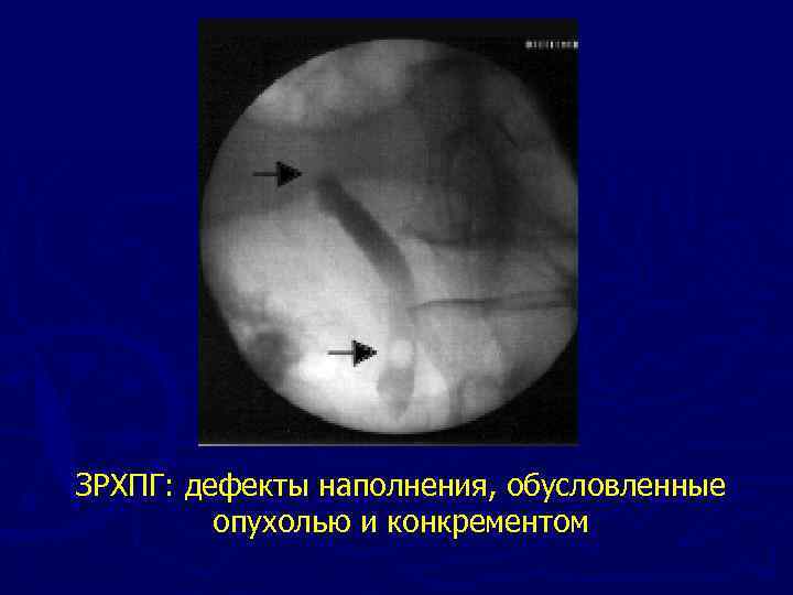 ЗРХПГ: дефекты наполнения, обусловленные опухолью и конкрементом 